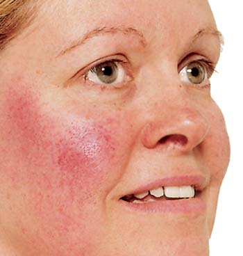 Tests & Diagnosis for Acne Rosacea