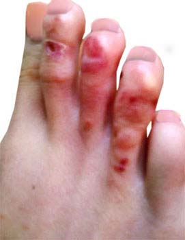 Summary of Athletes-foot