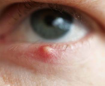 what is chalazion