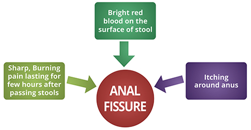 anal fissure symptoms