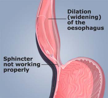 Achalasia Cardia Symptoms, Causes, & Homeopathic Treatments - WelcomeCure