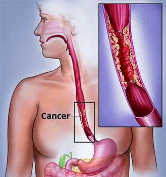 similar Conditions esophageal cancer