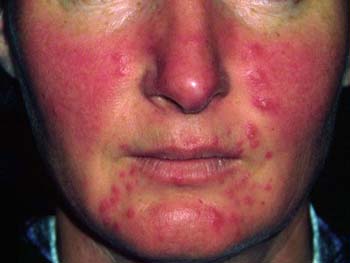 Introduction of Acne Rosacea