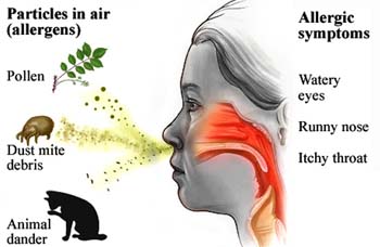 Causes of Allergic Rhinitis