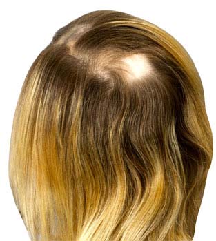 Summary of Alopecia Areata (Hair Loss)