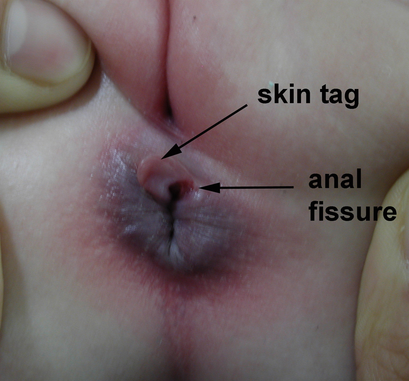 symptoms of anal fissure