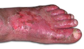 Complications of Athletes Foot