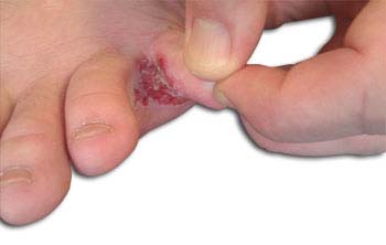 Definition of Athlete's Foot