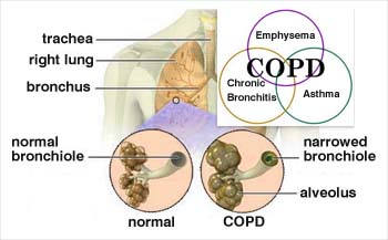 COPD_definition_2