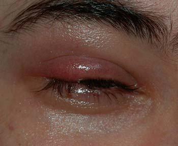 chalazion related conditions