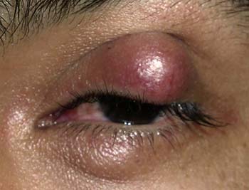 chalazion