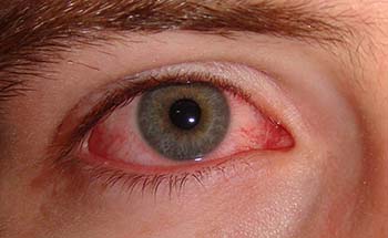 Conjunctivitis-Summary