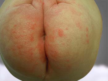 introduction of diaper dermatitis