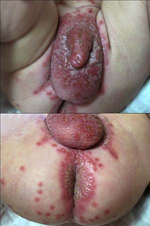 Genital Herpes is a highly infectious disease caused by the Herpes Simplex ...