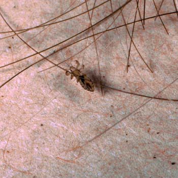 Risk Factors of Head Lice
