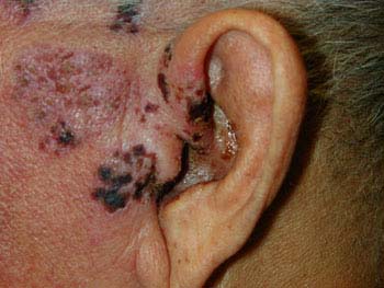 Complications of Herpes Zoster