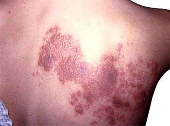 Complications of Herpes Zoster