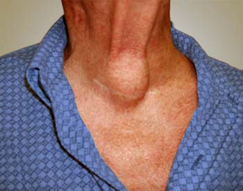 Similar Conditions of Hypothyroidism