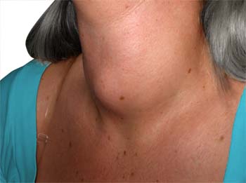 hypothyroidism symptoms disease welcomecure conditions depend severity duration sign