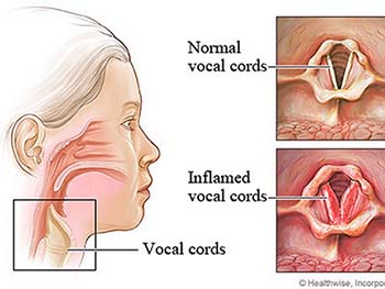 laryngitis definition