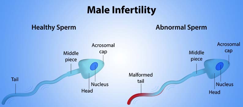 male infertility introduction