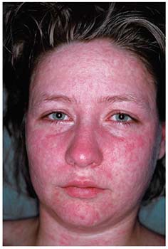 measles rash face