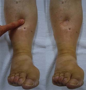 nephrotic syndrome edema