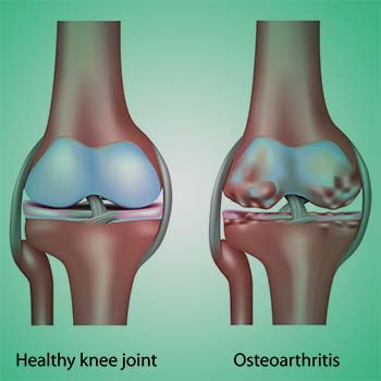 osteoarthritis