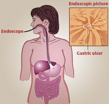 ulcer diagnosis and treatment