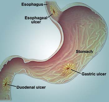 overview of peptic ulcer