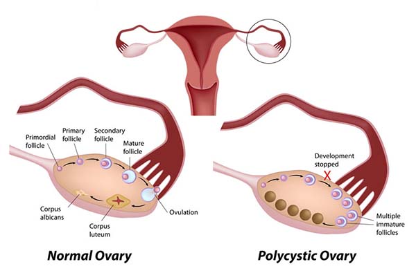 Polycystic Ovary Syndrome (PCOS) Defination