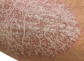 Summary of Psoriasis