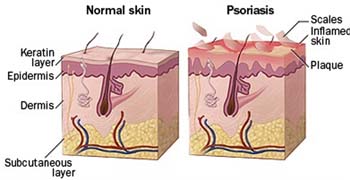 Summary of Psoriasis
