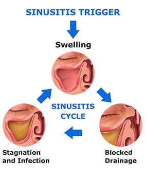 Definition of Sinusitis