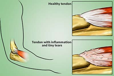 Definition of Tennis Elbow