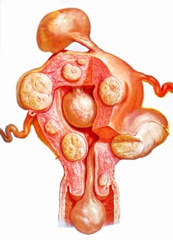 Summary of Uterine Fibroids