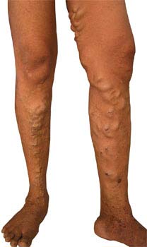 Introduction of Varicose Veins