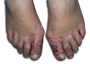 Similar Conditions of Athlete's Foot
