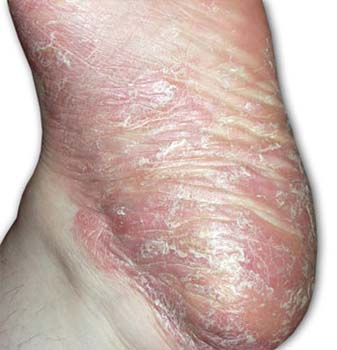 Similar Conditions of Athlete's Foot