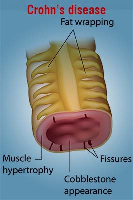 crohns disease