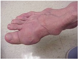 Summary of Gout
