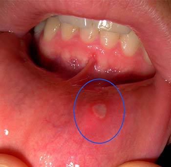 mouth ulcers introduction