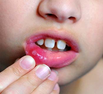 mouth ulcers symptoms