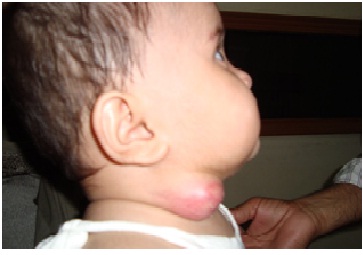 Before treatment Abscess-case img1