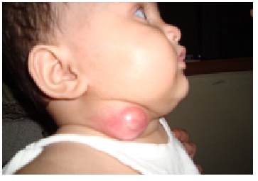 Before_treatment_Abscess-case_img2