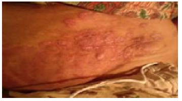 Before treatement Psoriasis case12 Img1