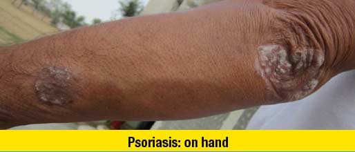 After Treatment Psoriasis on hand