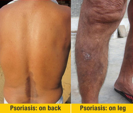 After the treatment Psoriasis On Back And Leg