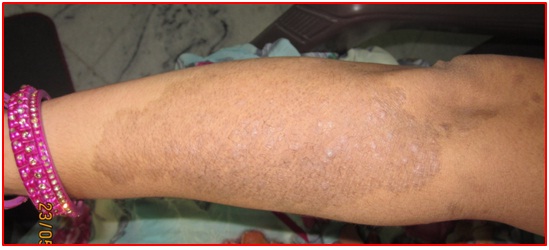 Before Treatment Psoriasis on Hand